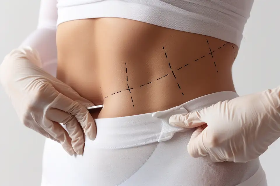 Abdominoplasty Candidate