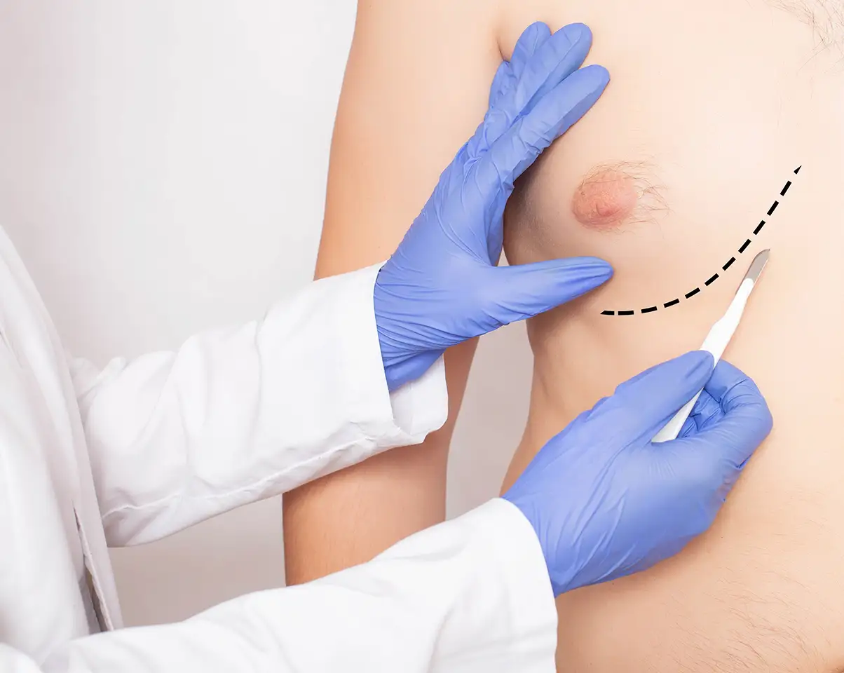 Gynecomastia Surgery Candidate